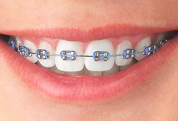 brackets metalicos